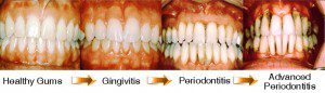 Gingivite Parodontite