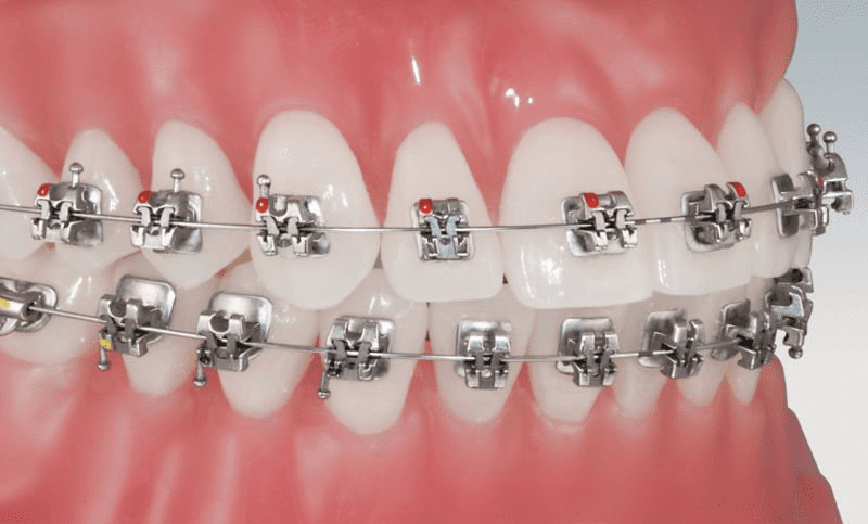 Best Dental Braces Starts @ Rs1000- Metal, Ceramic Braces